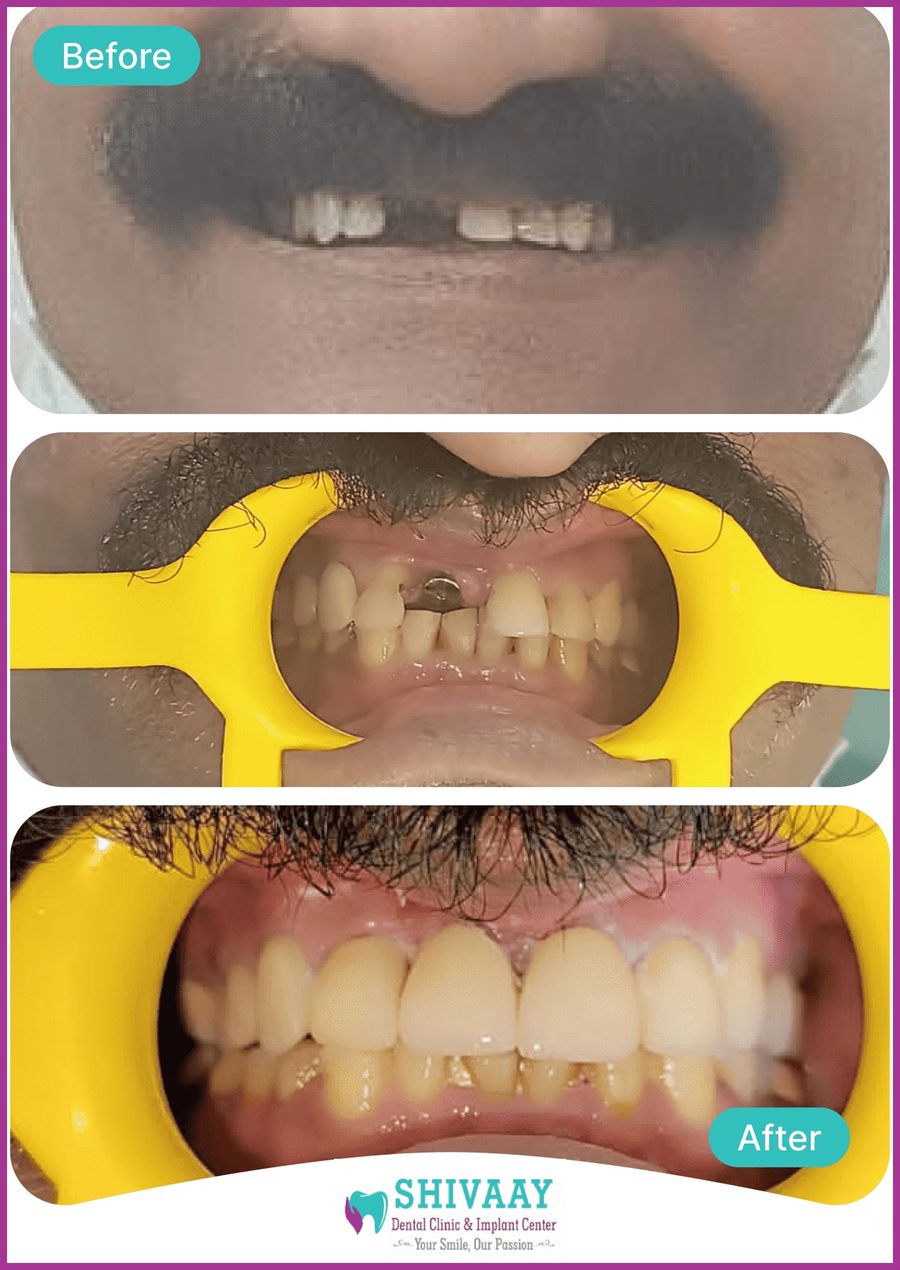 Before and after photographs of a dental implant case