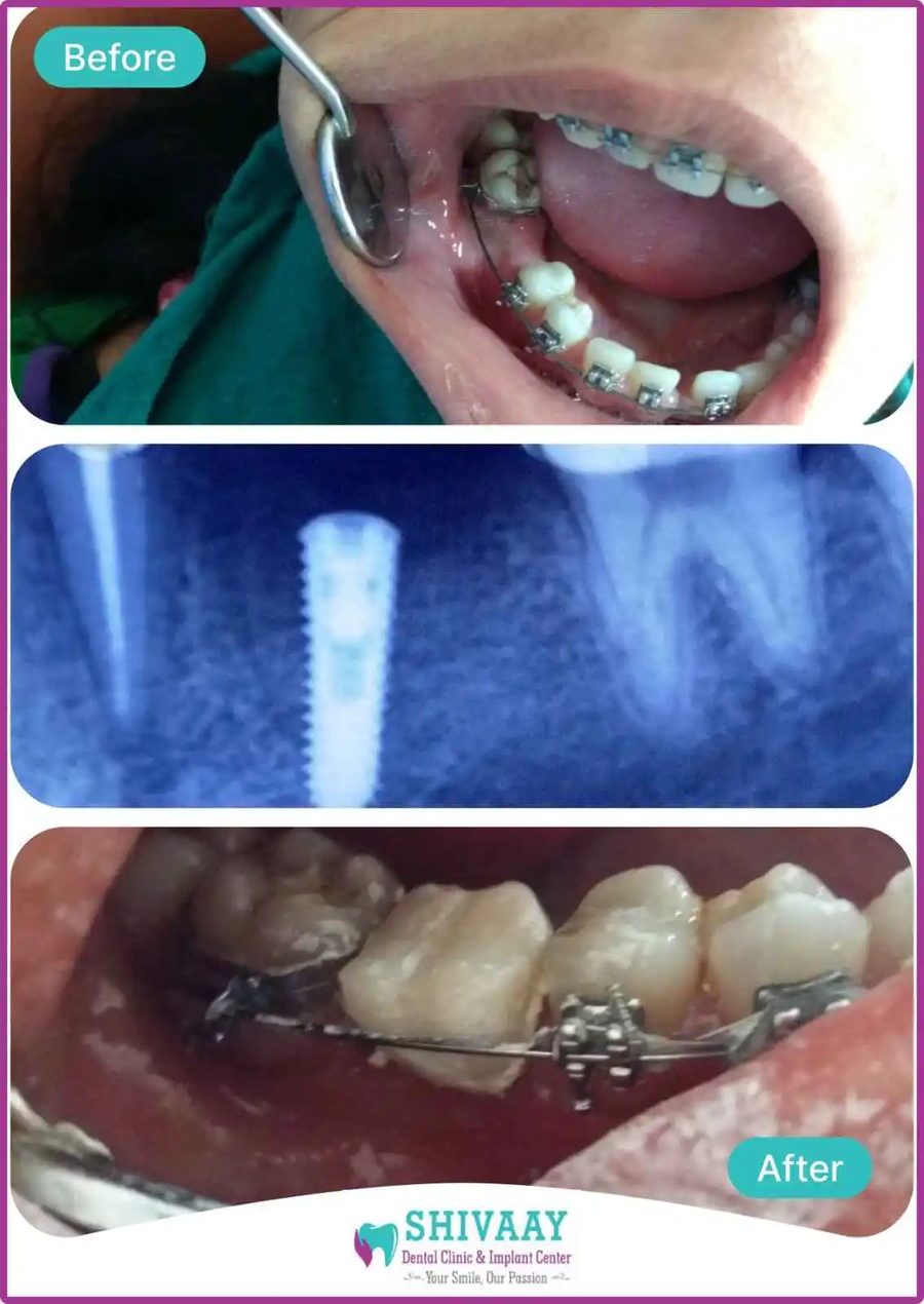 Before, X-ray and after photographs of an implant case