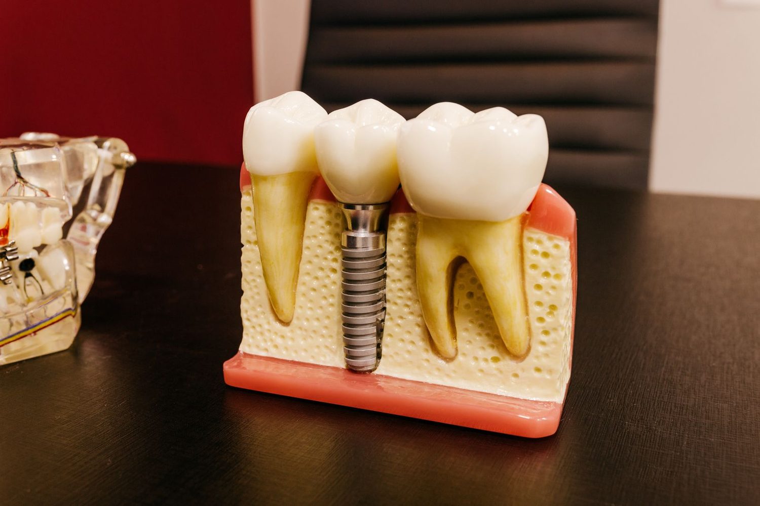 Dental implant model with a crown beside a bridge