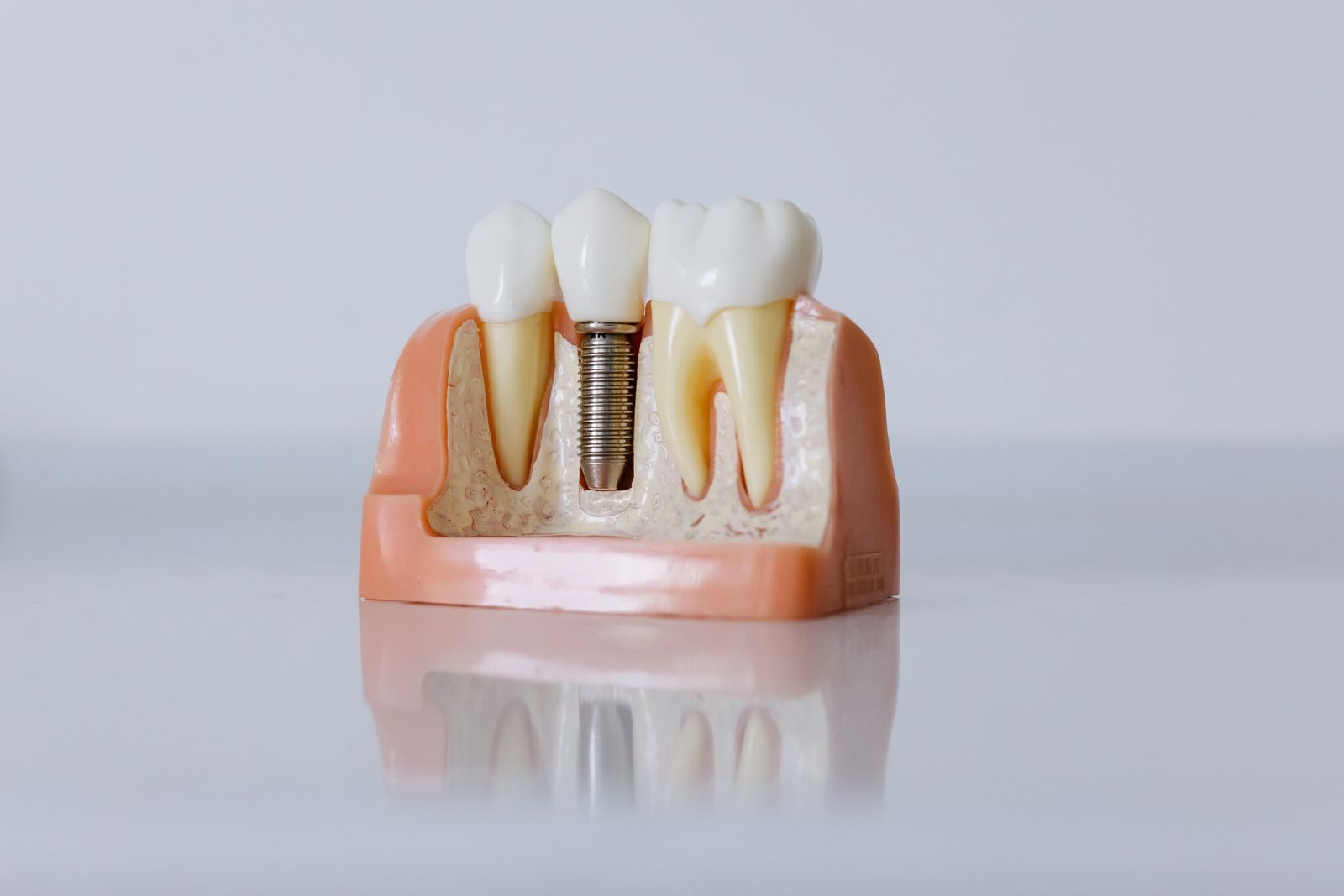 Dental implant model showing a titanium implant supporting a crown