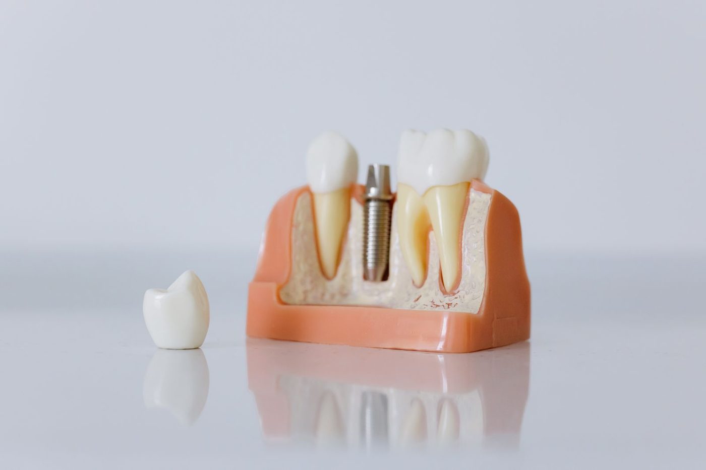 Transparent jaw model showing dental implants